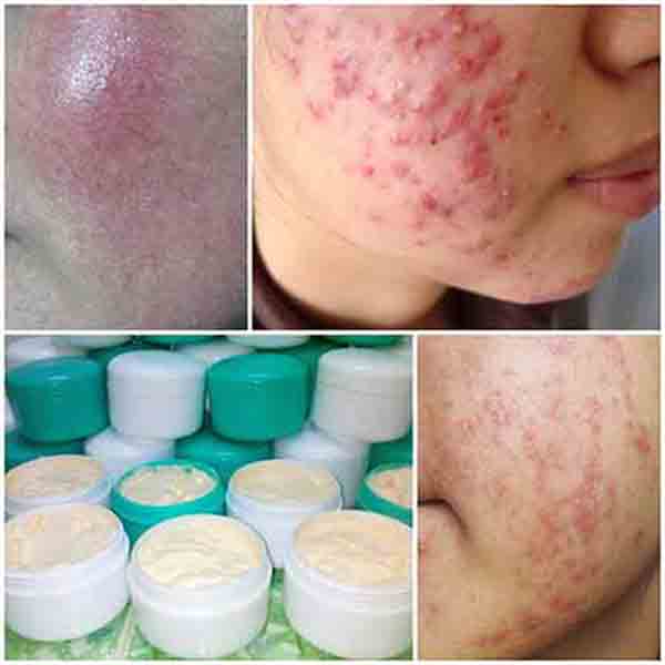 Da bị nghiện corticoid như thế nào? - Bác sĩ Văn