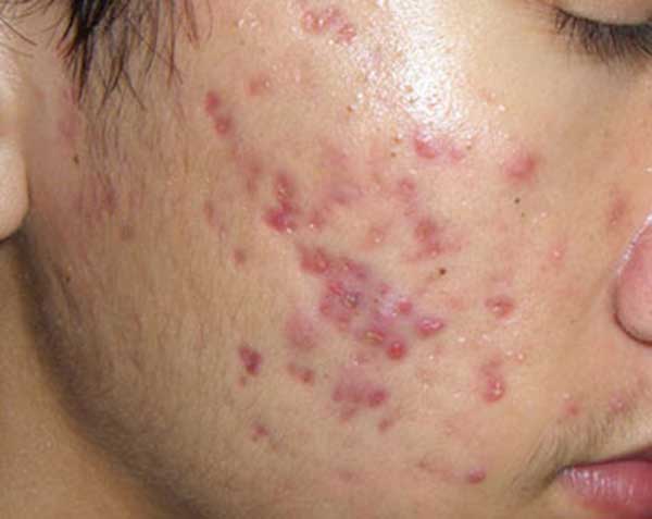 Các vấn đề về da sau mụn