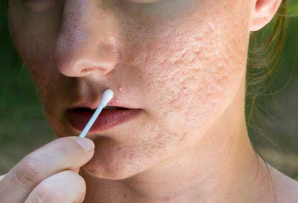 3 công thức trị sẹo lõm tại nhà hiệu quả nhất
