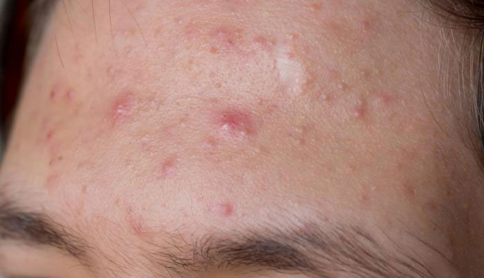 Tất tần tật về mụn ẩn dưới da