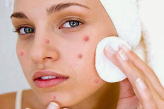 Tất tần tật về mụn trứng cá