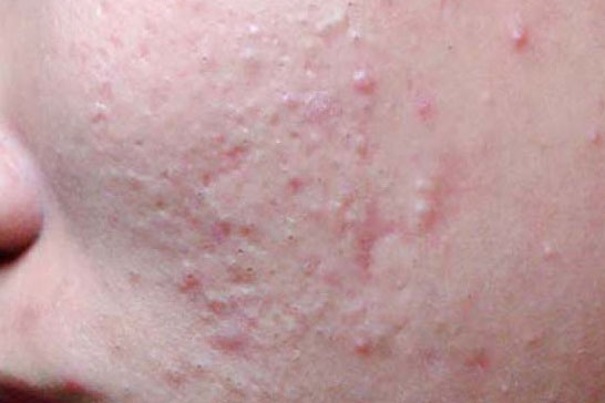 Những bước cần thiết để xử lý và ngăn ngừa mụn ẩn dưới da