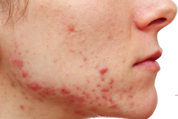 Nhận diện chính xác mụn do nội tiết tố gây nên