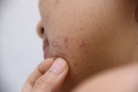 Tôi đã 35 tuổi, tại sao vẫn chưa hết mụn?