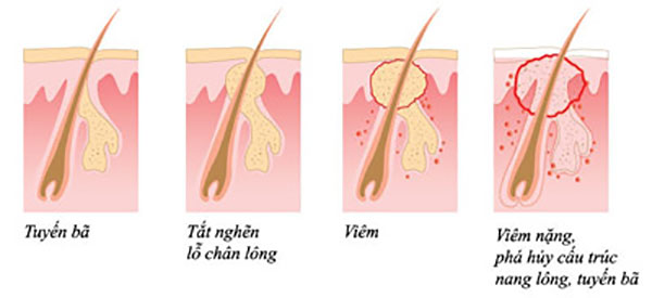 Vòng đời của mụn và phương pháp điều trị đúng cách