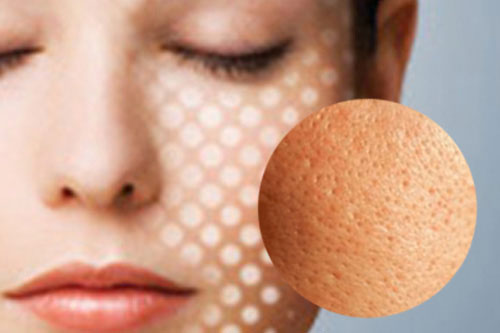 Lỗ chân lông to và biện pháp khắc phục