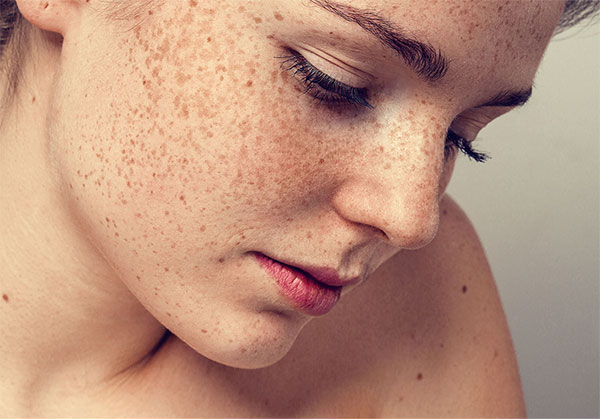 Tại sao điều trị hoài mà nám da không hết?