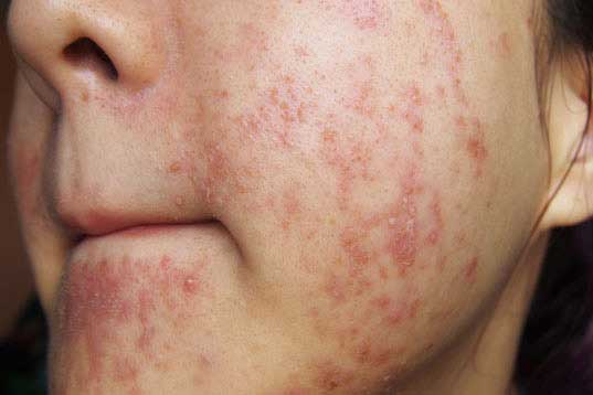 Cách xử lý khi da bị dị ứng mỹ phẩm