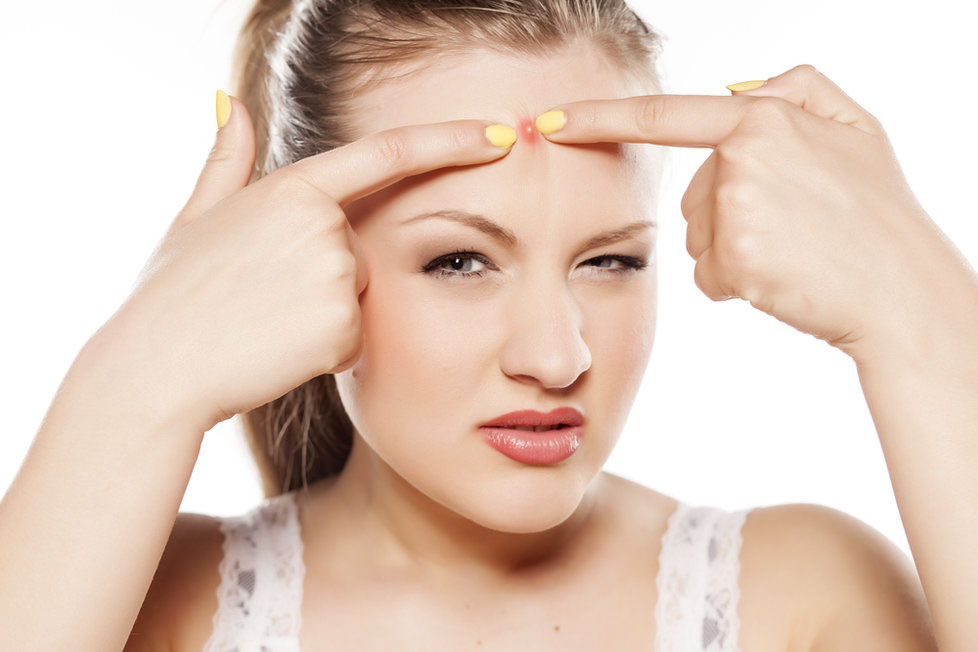 5 loại mụn tuyệt đối không tự ý nặn để tránh gây nhiễm trùng nghiêm trọng