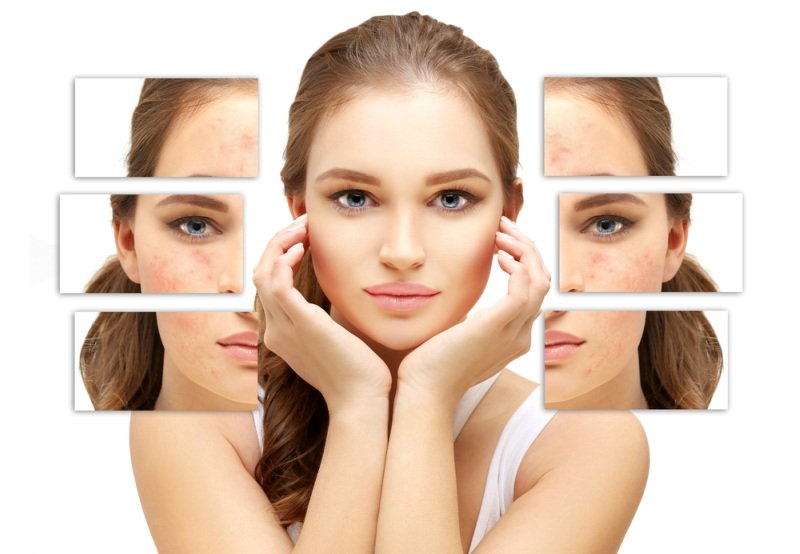 XÓA TAN NỔI LO VỀ MỤN TRONG NHỮNG NGÀY TẾT