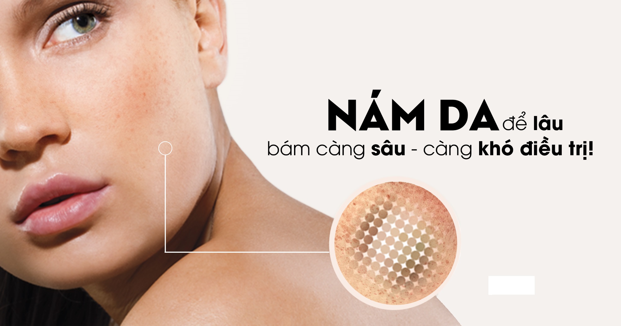 Triệt tiêu “kẻ thù truyền kiếp” của phụ nữ - Nám, tàn nhang