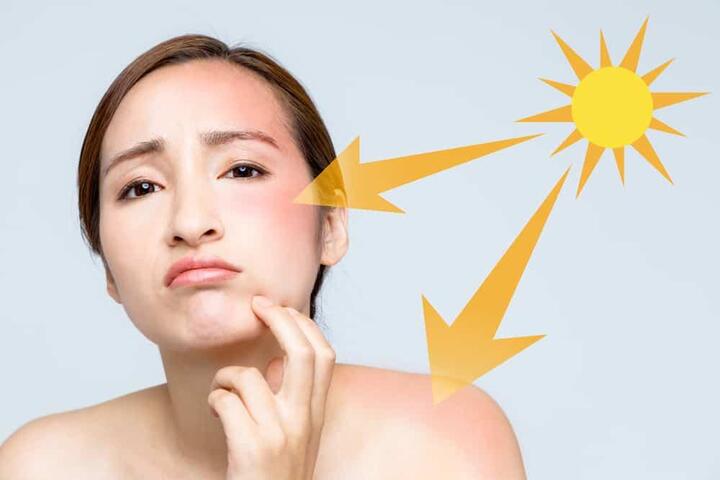 Nám do nắng: Nguyên nhân và cách khắc phục