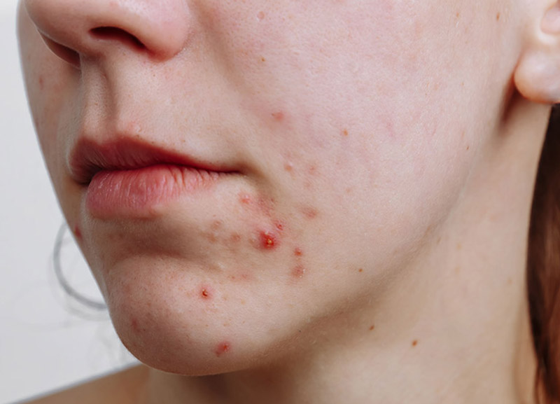 Mụn trứng cá - Biểu hiện, nguyên nhân, cách điều trị