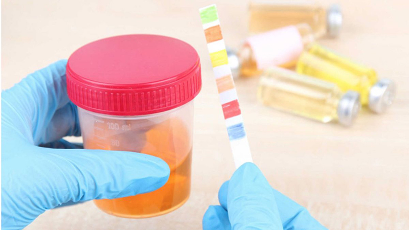 Giải mã ý nghĩa của chỉ số Ascorbic Acid trong nước tiểu