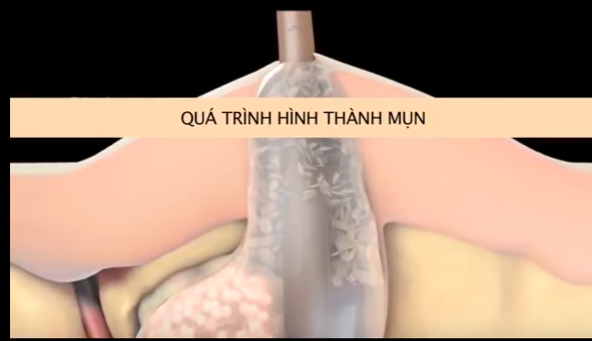 Quy trình hình thành, phát triển của mụn trên da
