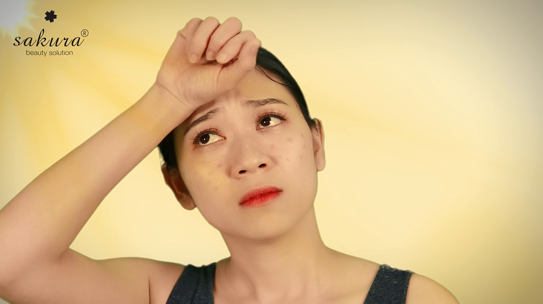 Điều trị nám - Những nguyên tắc cần nắm rõ